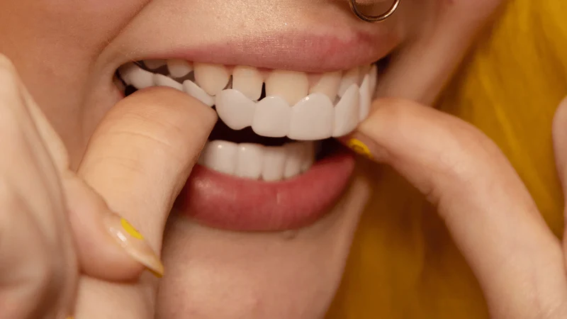 Snap on Smile Veneers